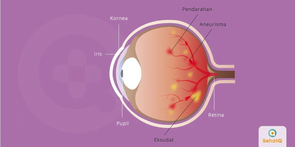 sakit mata retina